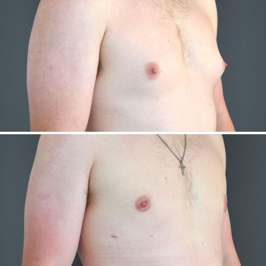 Canberra Gynecomastia Male Chest 2023 Left Cp01 Before And After