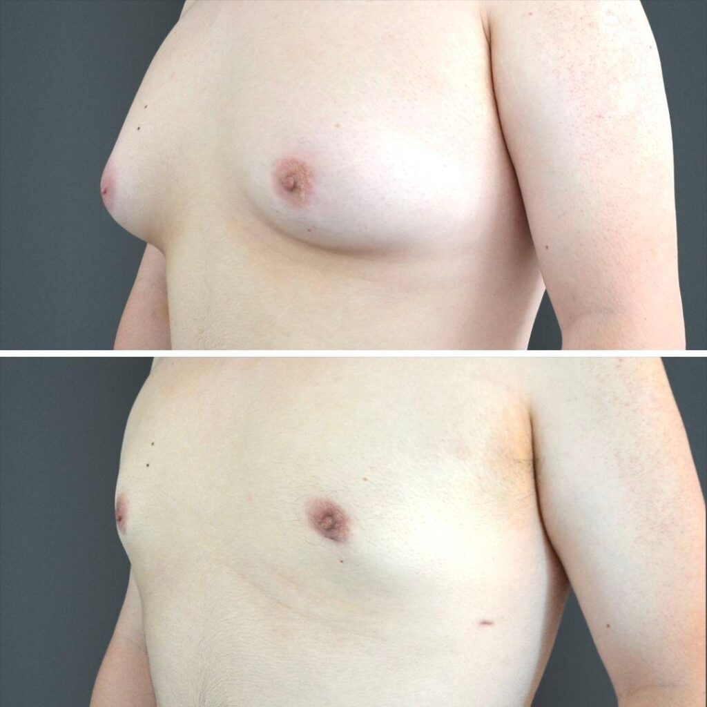 Canberra Gynecomastia Male Chest 2023 Right Cp02 Before And After