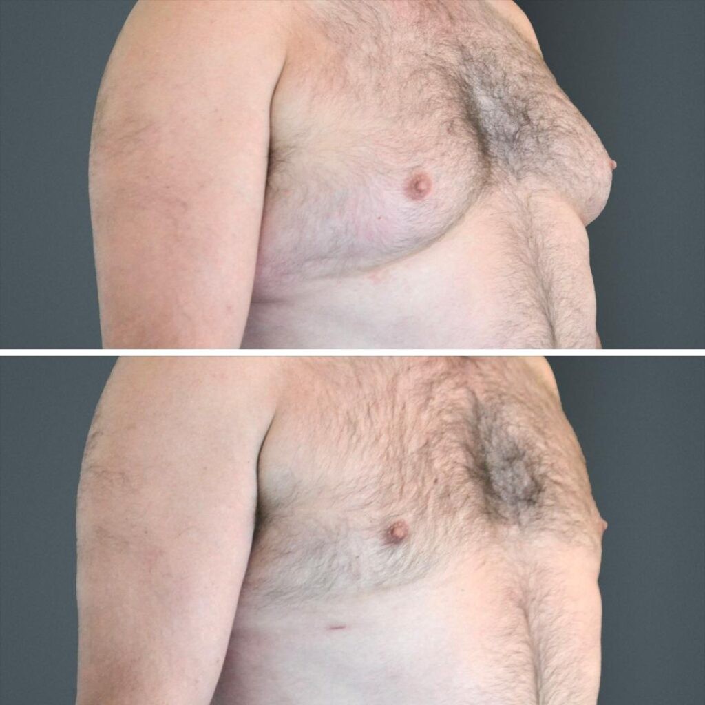 Canberra Gynecomastia Male Right 2023 Front Sc Before And After