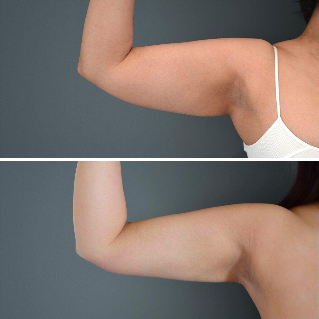 Canberra Liposuction Arm Female 2022 Front Ra Before And After