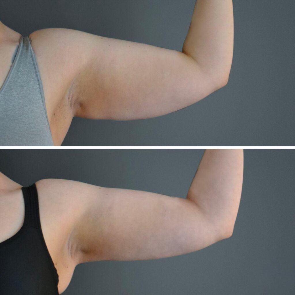 Canberra Liposuction Arm Female 2022 Left Tc Before And After
