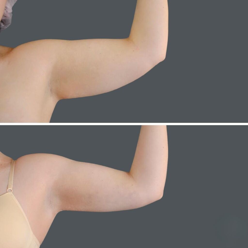 Canberra Liposuction Arm Female Left Oc Before And After