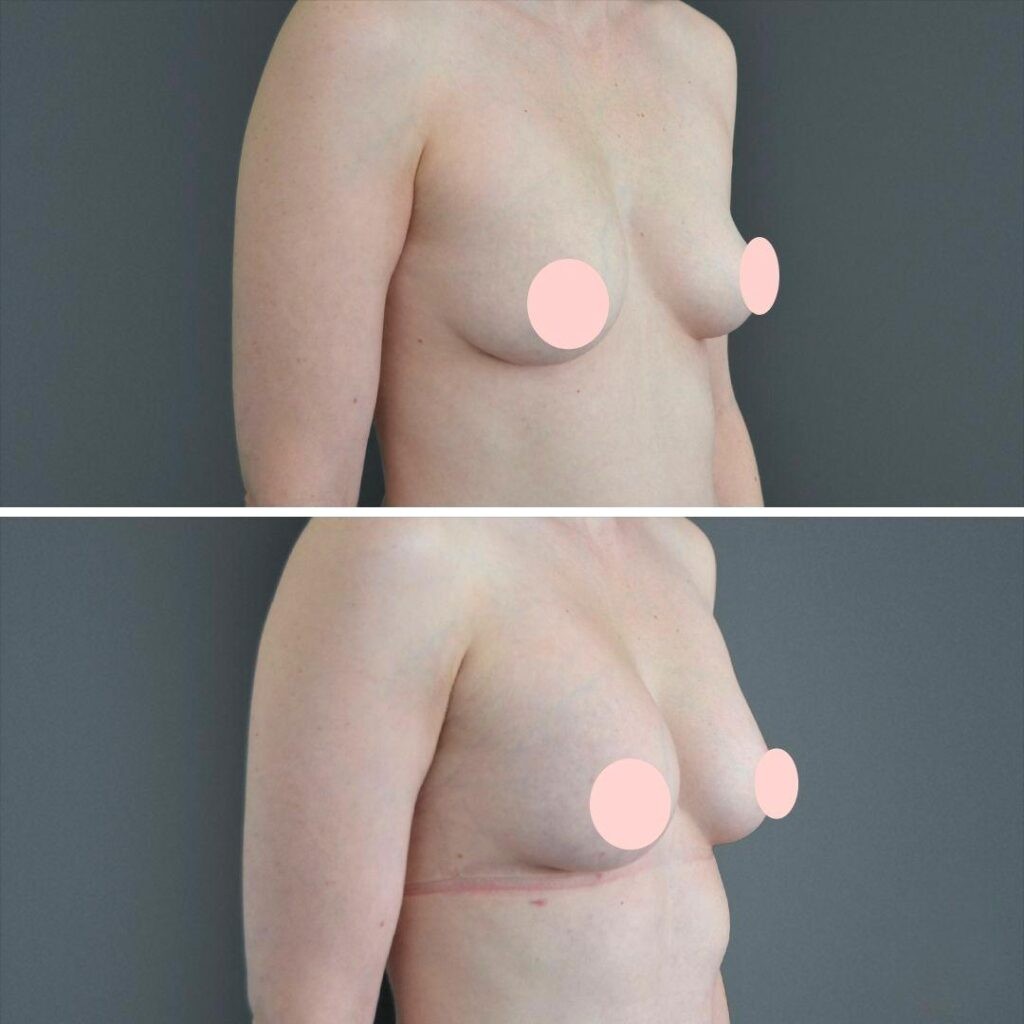 Canberra Liposuction Breast Female 2022 Left Sb Before And After