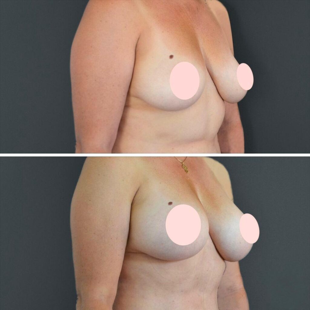 Canberra Liposuction Breast Female 2022 Left Ts Before And After