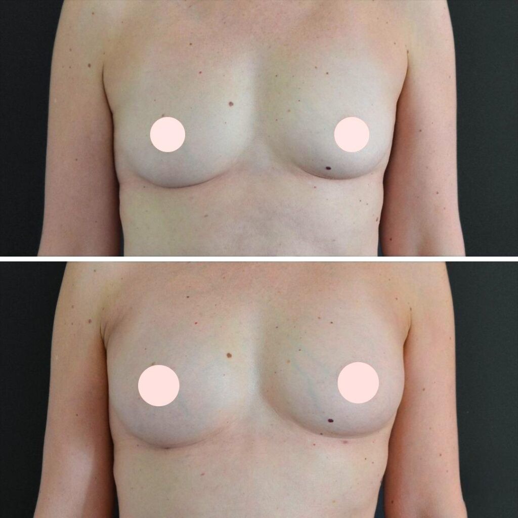 Canberra Liposuction Breast Female 2022 Right Ea Before And After