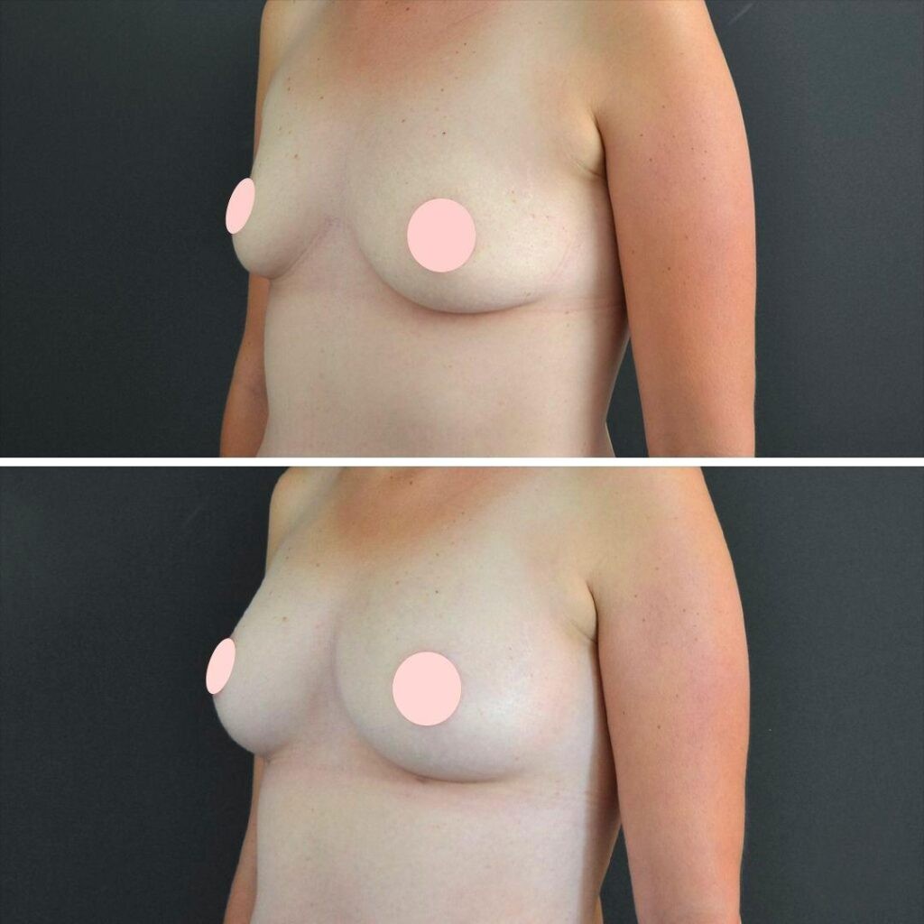 Canberra Liposuction Breast Female 2022 Right Et Before And After