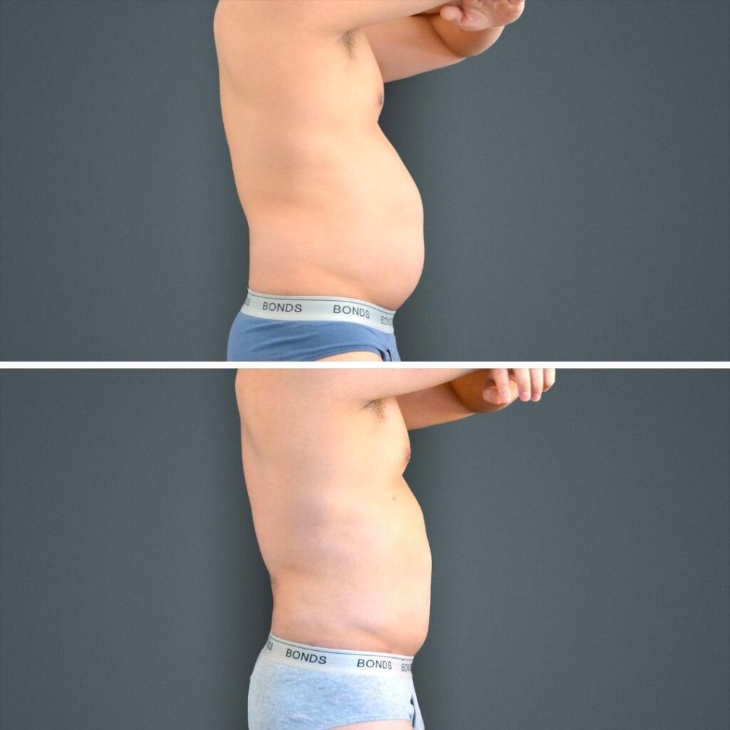 Canberra Liposuction Stomach Male 2023 Left Mv Before And After