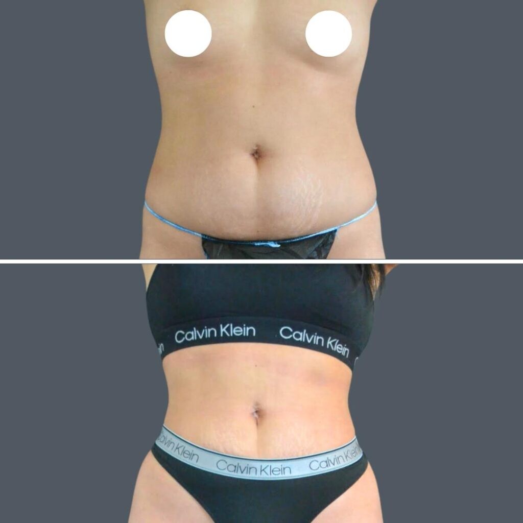 Canberra Stomach Liposuction Female 2024 Kp 001 Before And After
