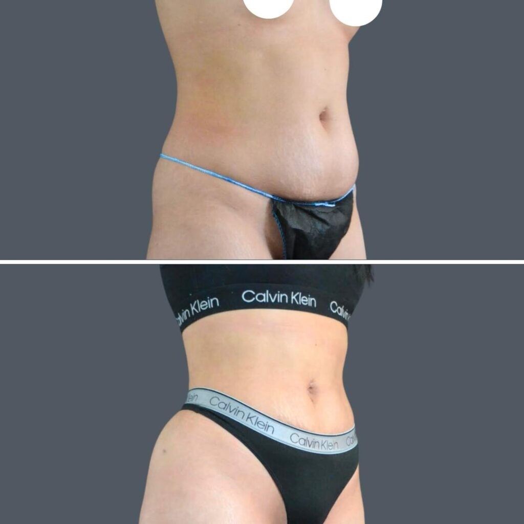 Canberra Stomach Liposuction Female 2024 Kp 002 Before And After