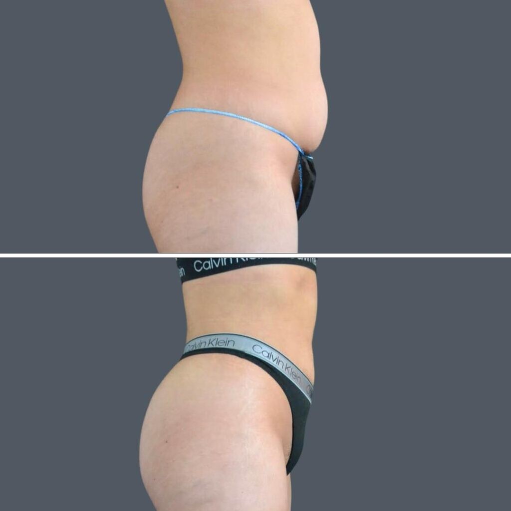 Canberra Stomach Liposuction Female 2024 Kp 003 Before And After