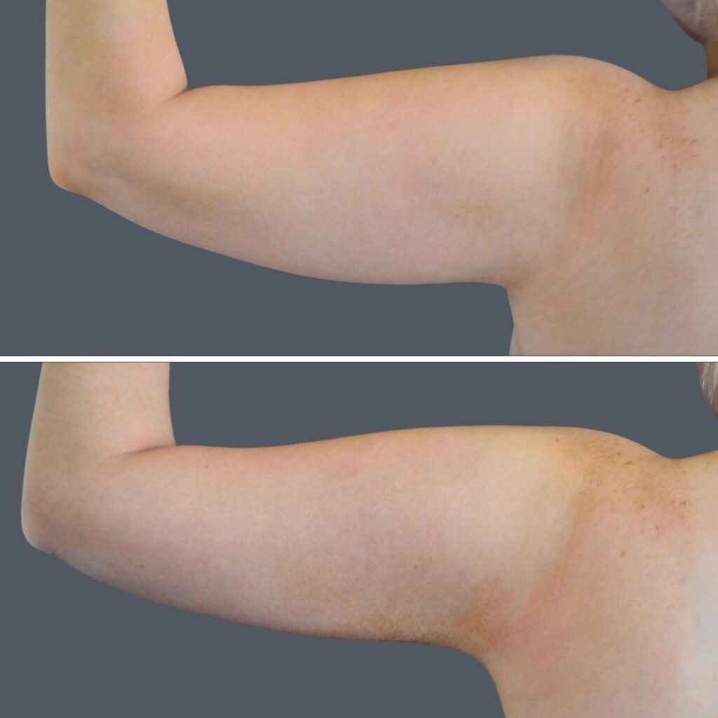 Canberra Vaser Liposuction Arms Female 2024 Cb 001 Before And After
