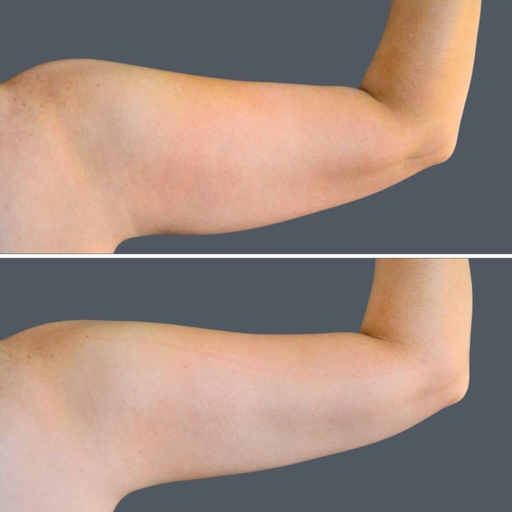 Canberra Vaser Liposuction Arms Female 2024 Cb 002 Before And After