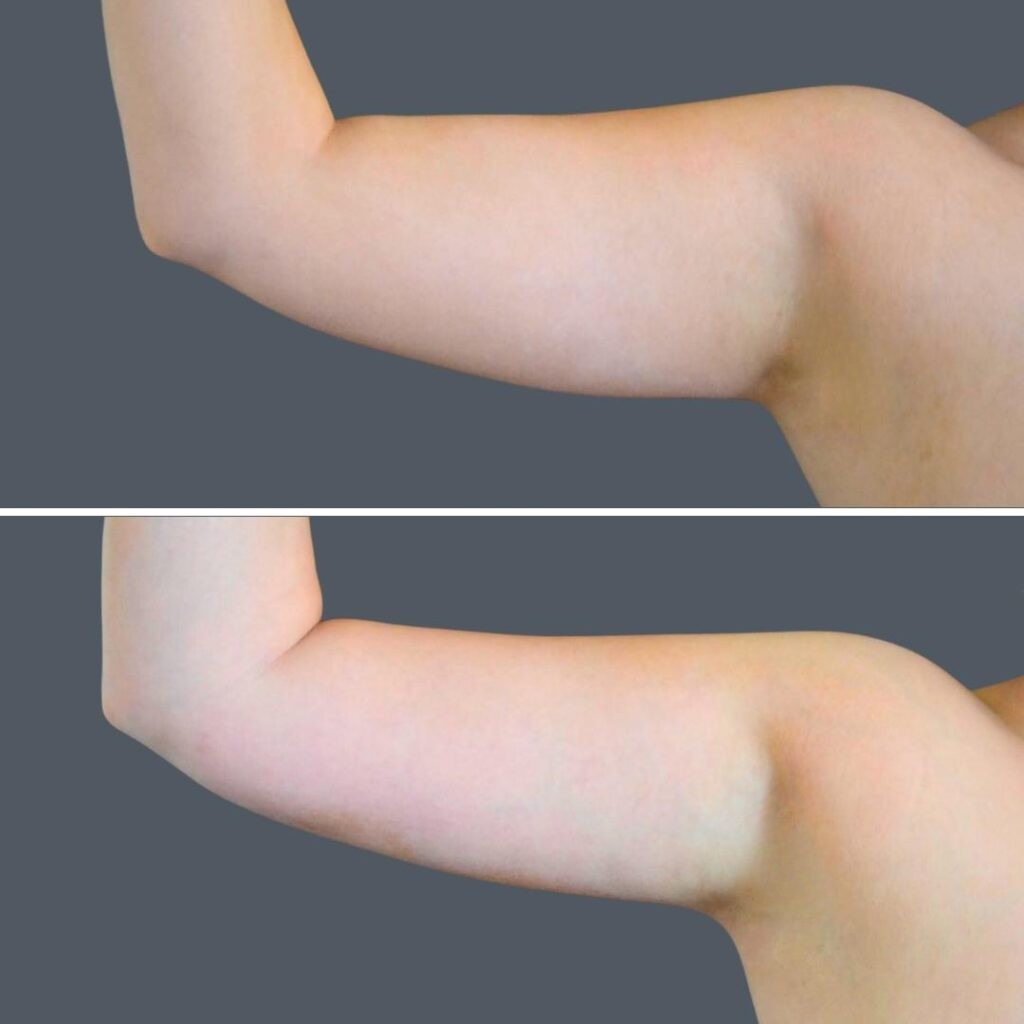 Canberra Vaser Liposuction Arms Female 2024 Cb 003 Before And After