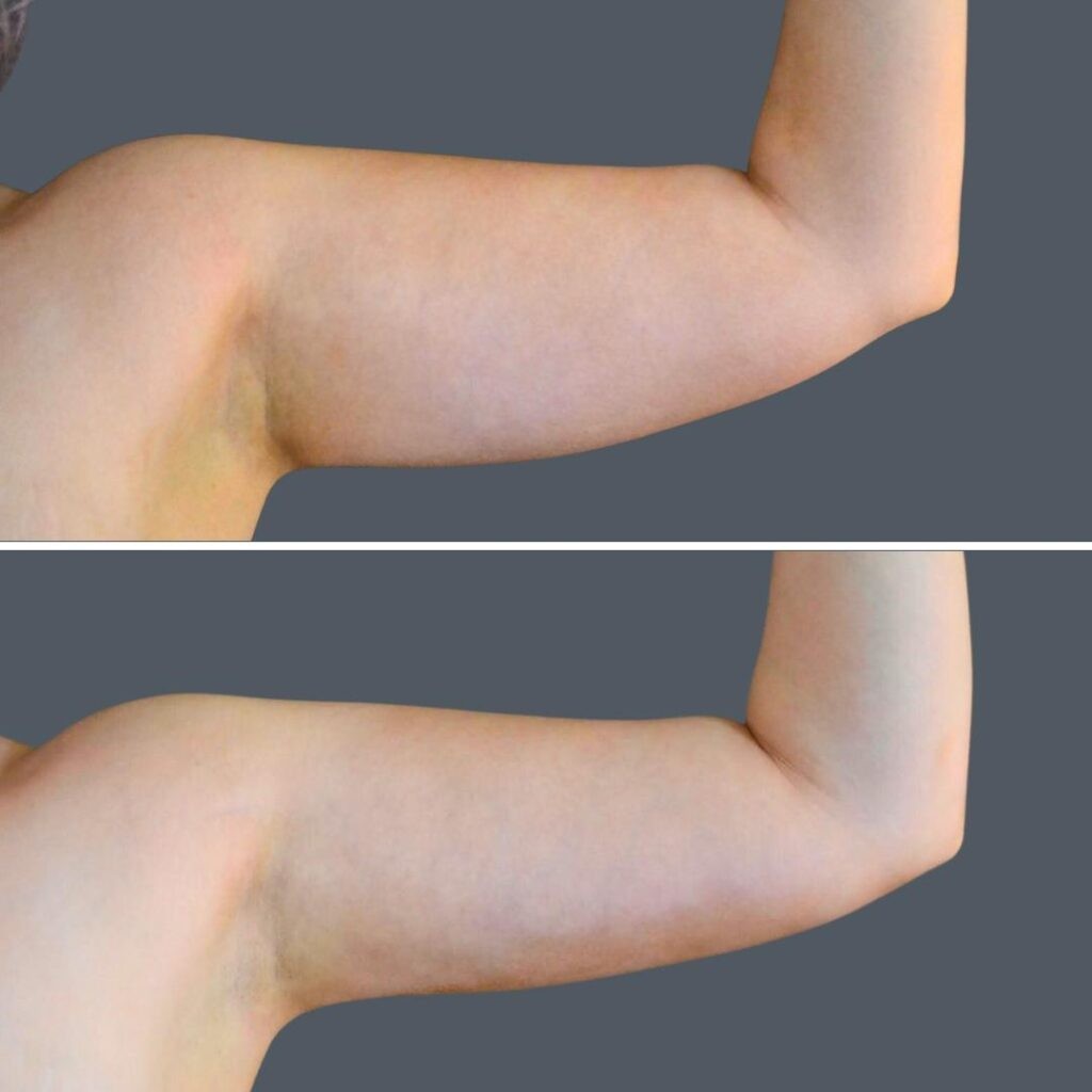Canberra Vaser Liposuction Arms Female 2024 Cb 004 Before And After
