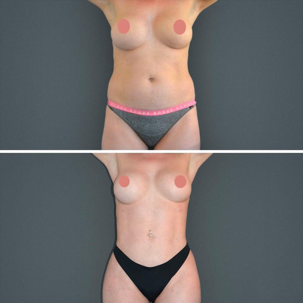 Canberra Vaserhidefliposuction Stomach Female 2022 Front Aw Before And After