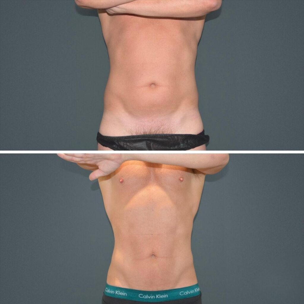 Canberra Vaserhidefliposuction Stomach Male 2022 Front Aw Before And After