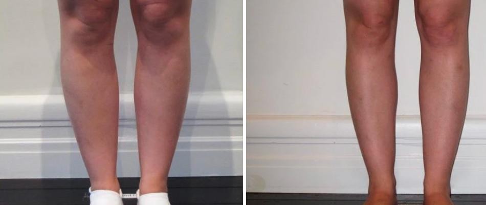 Cankle Liposuction Female Pre2024 002 Before And After