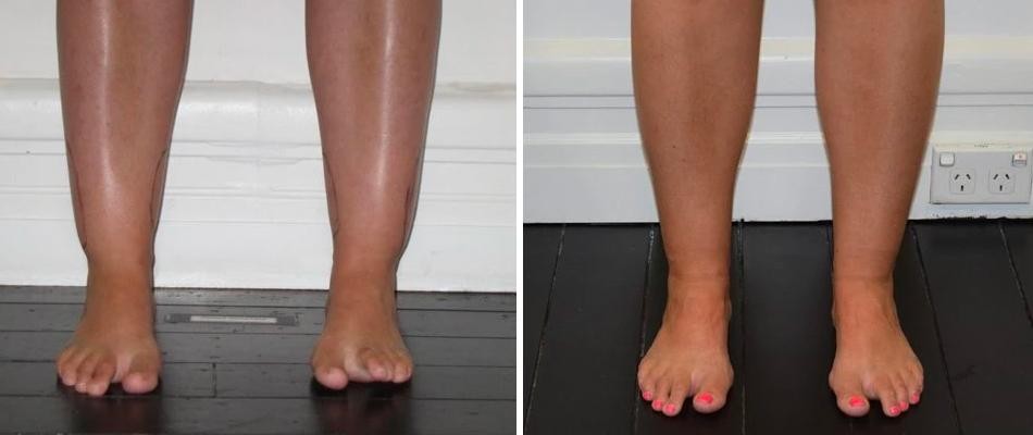 Cankle Liposuction Female Pre2024 005 Before And After