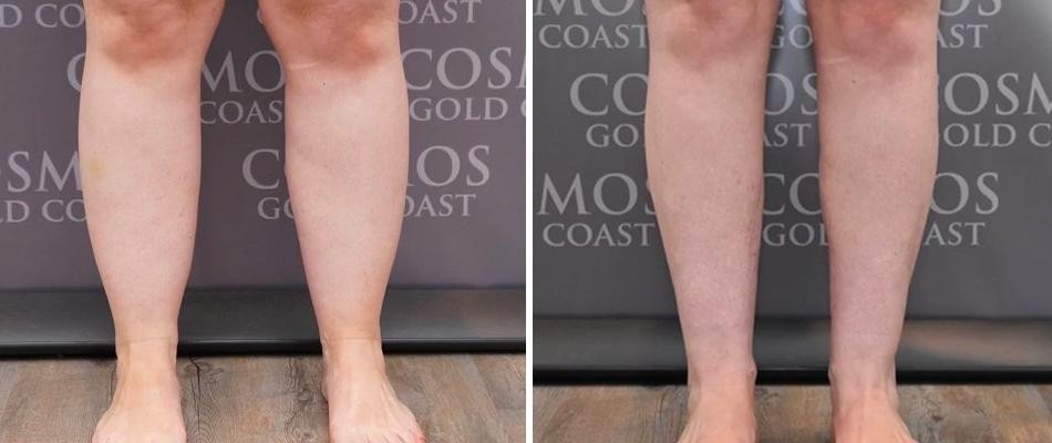 Cankle Liposuction Male Pre2024 003 Before And After