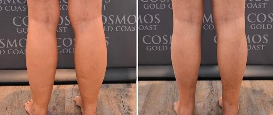 Cankle Liposuction Male Pre2024 004 Before And After