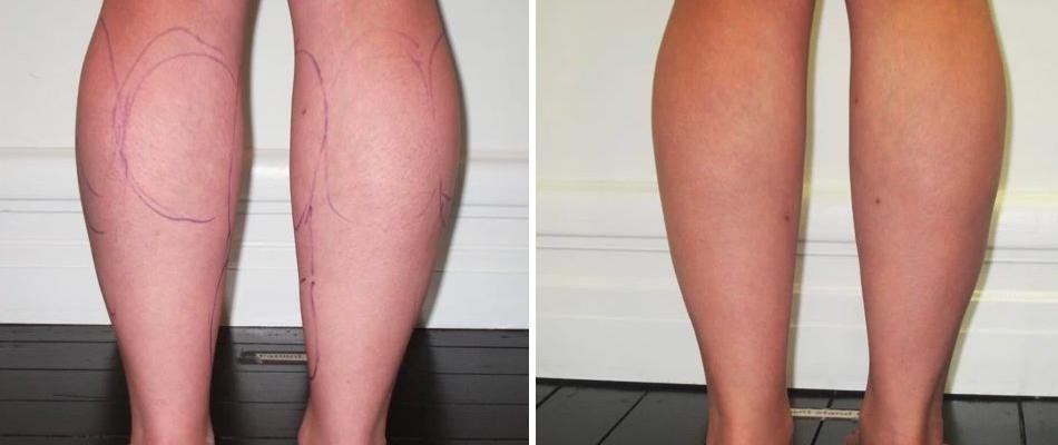 Cankle Liposuction Male Pre2024 006 Before And After