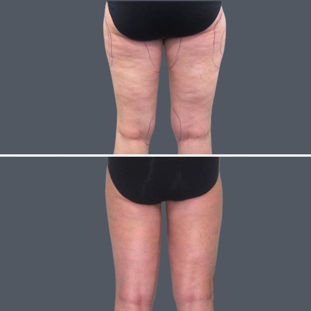 Cellulite Reduction Female Pre2024 001 Before And After
