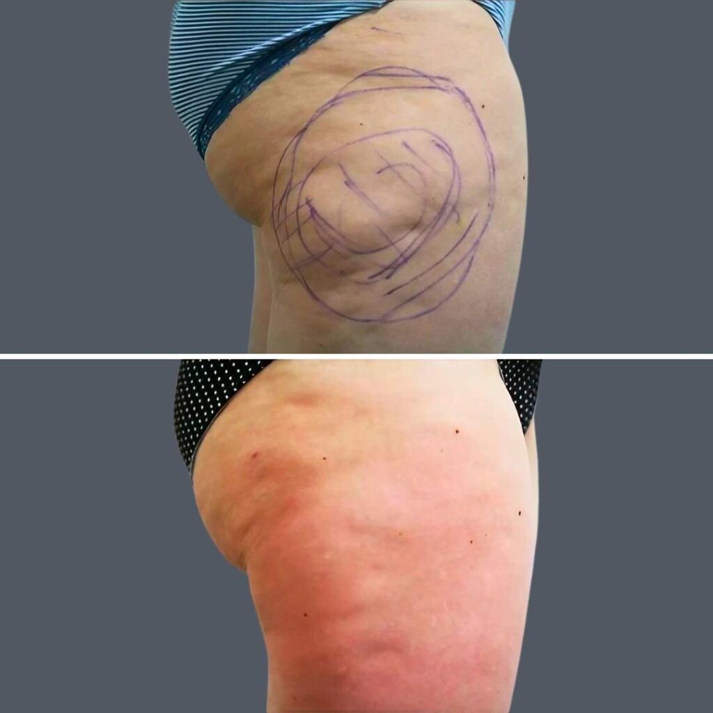 Cellulite Reduction Female Pre2024 002 Before And After