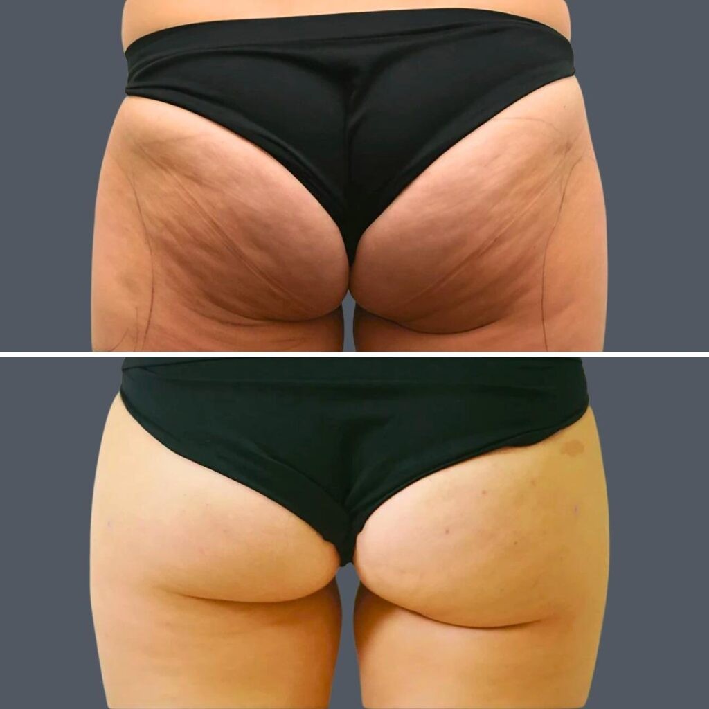 Cellulite Reduction Female Pre2024 003 Before And After