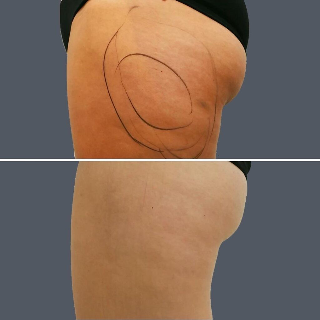 Cellulite Reduction Female Pre2024 004 Before And After