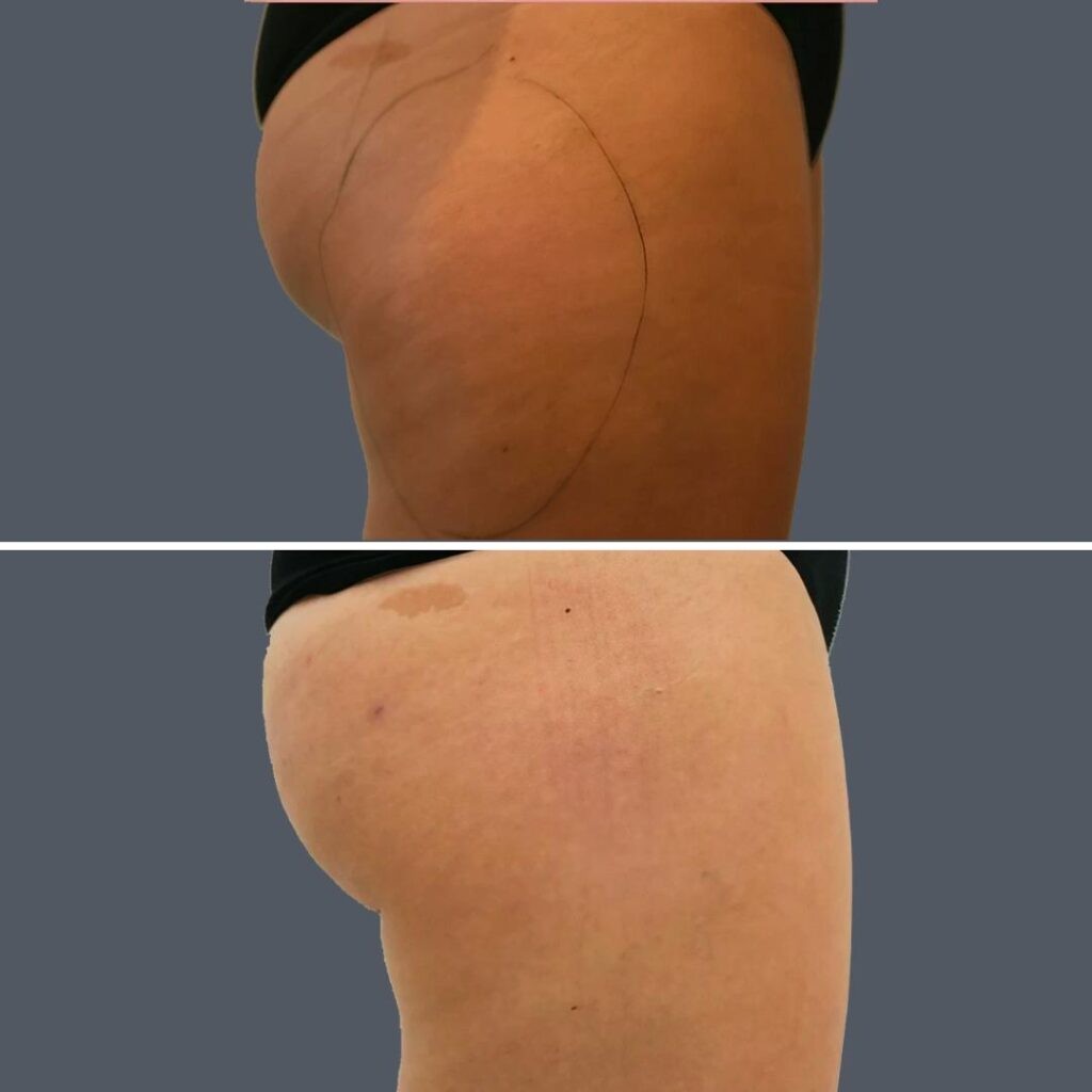 Cellulite Reduction Female Pre2024 005 Before And After