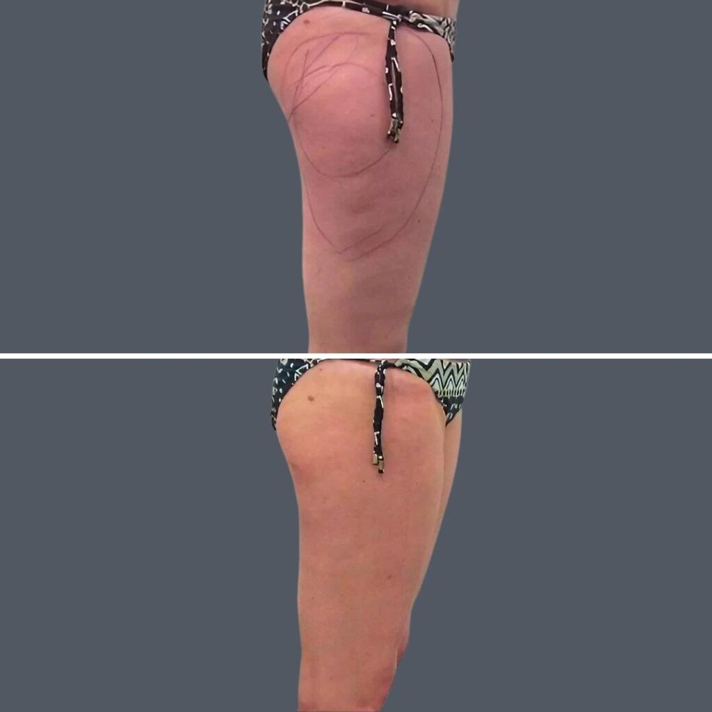 Cellulite Reduction Female Pre2024 006 Before And After