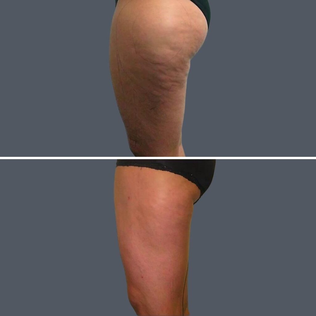 Cellulite Reduction Female Pre2024 007 Before And After