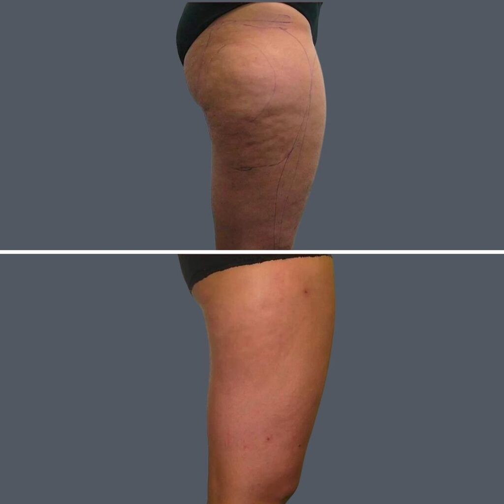 Cellulite Reduction Female Pre2024 008 Before And After