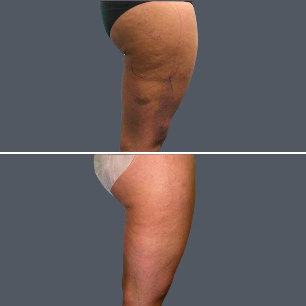Cellulite Reduction Female Pre2024 009 Before And After