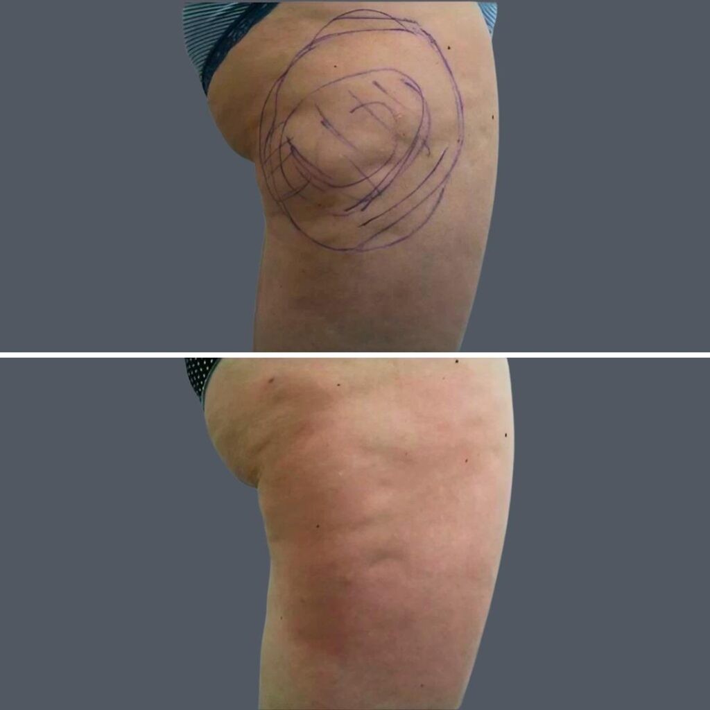 Cellulite Reduction Female Pre2024 010 Before And After