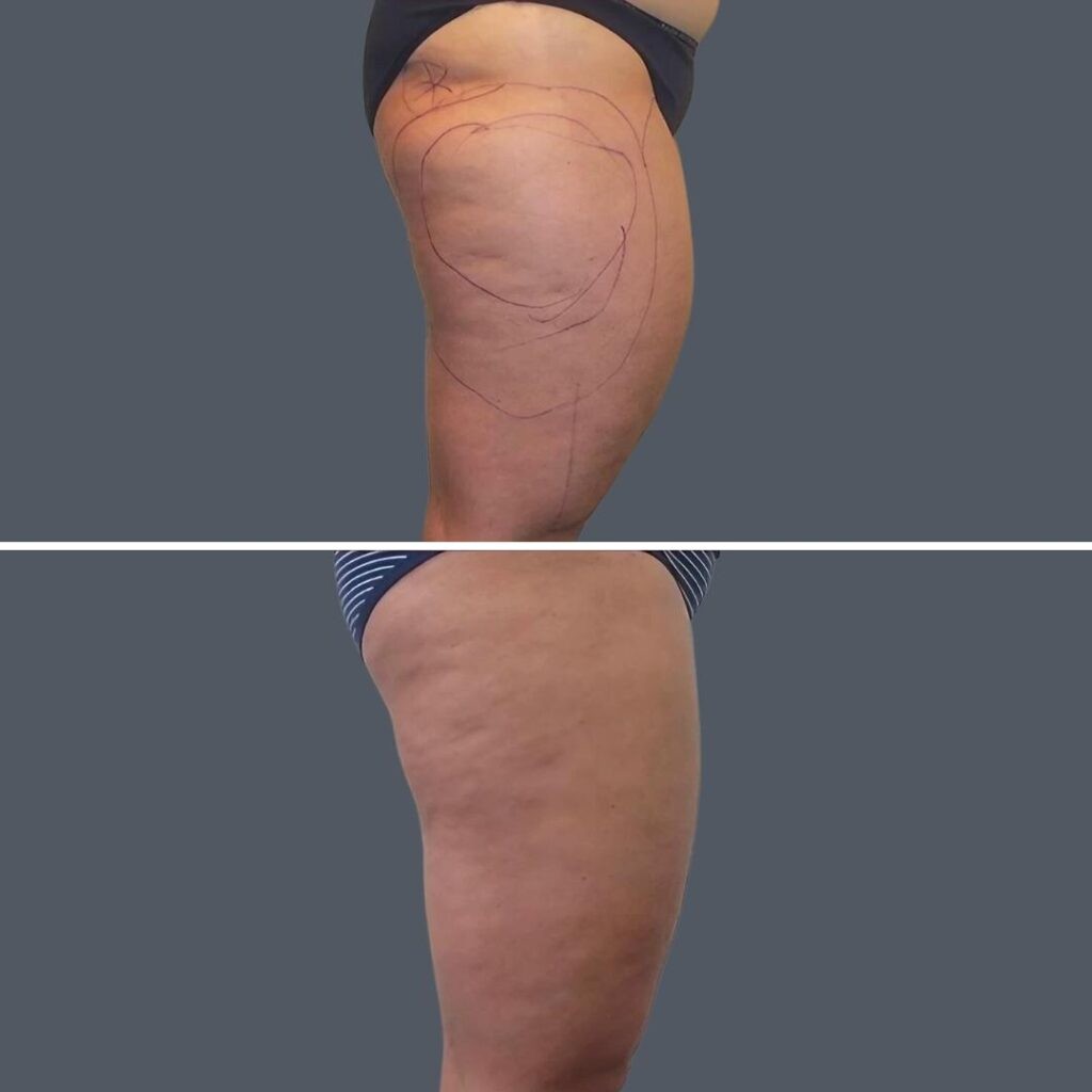Cellulite Reduction Female Pre2024 011 Before And After