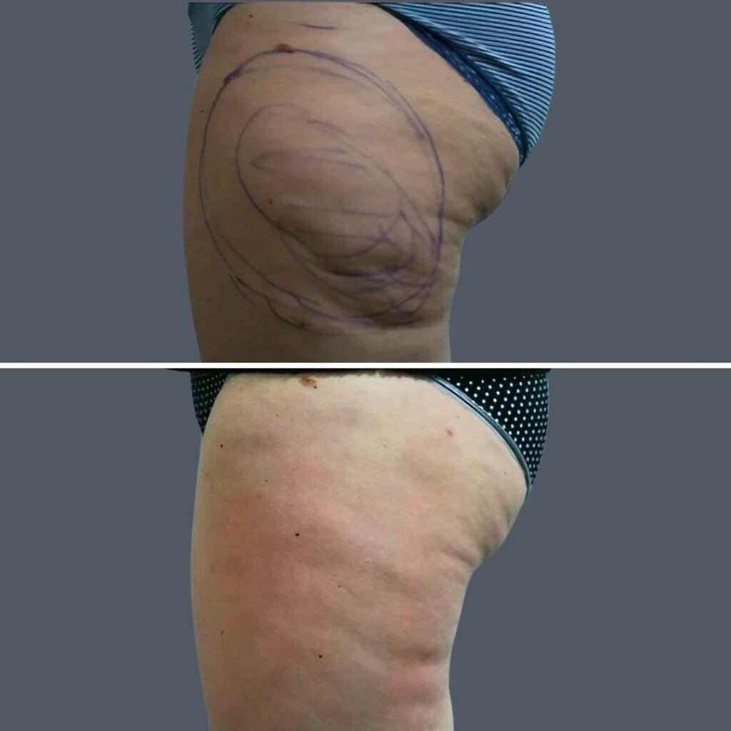 Cellulite Reduction Female Pre2024 012 Before And After