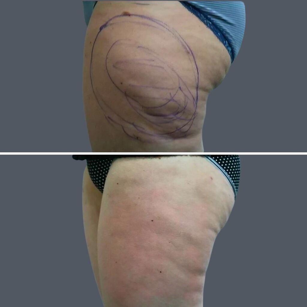 Cellulite Reduction Female Pre2024 013 Before And After
