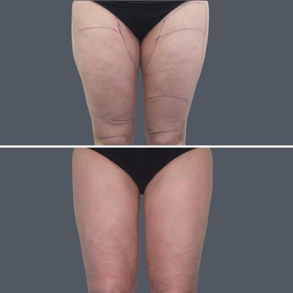 Cellulite Reduction Female Pre2024 014 Before And After