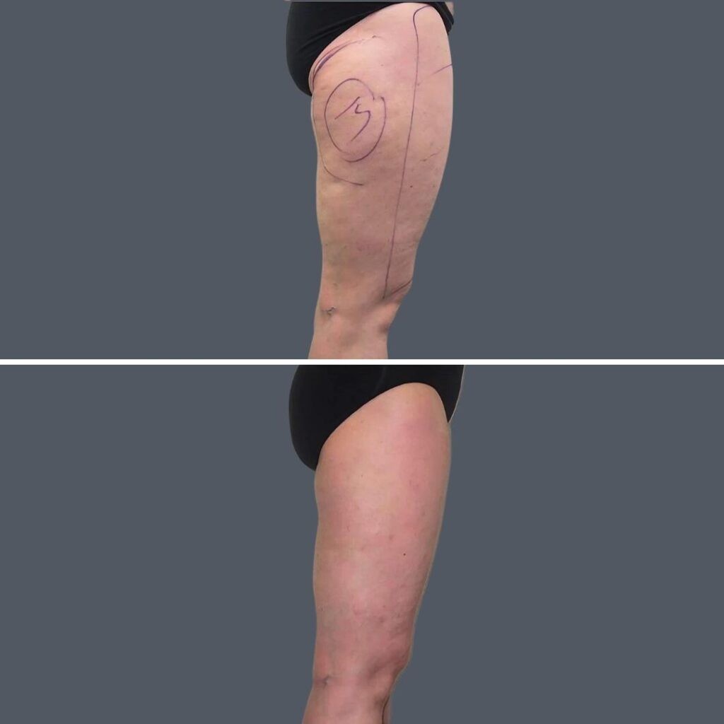 Cellulite Reduction Female Pre2024 015 Before And After