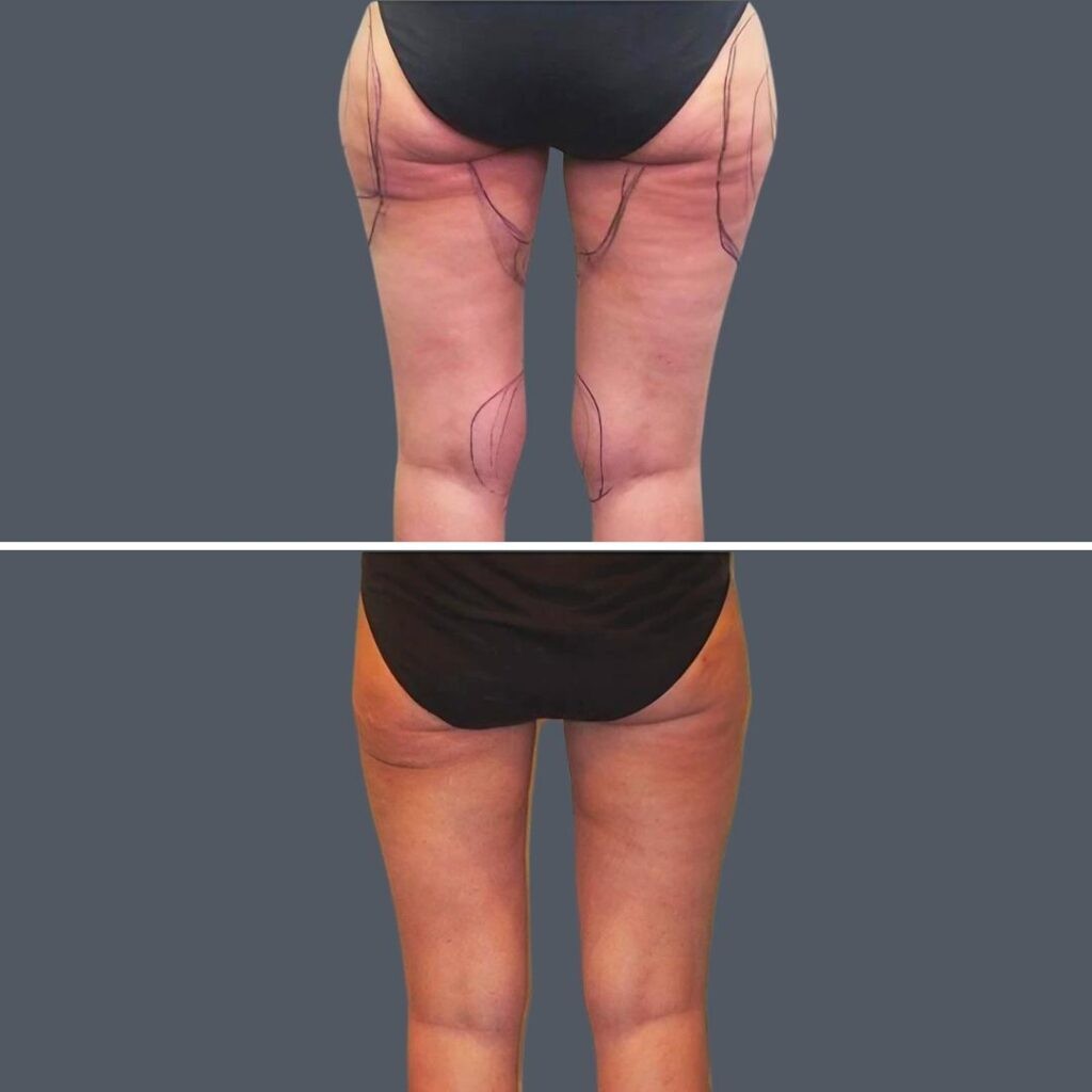 Cellulite Reduction Female Pre2024 016 Before And After