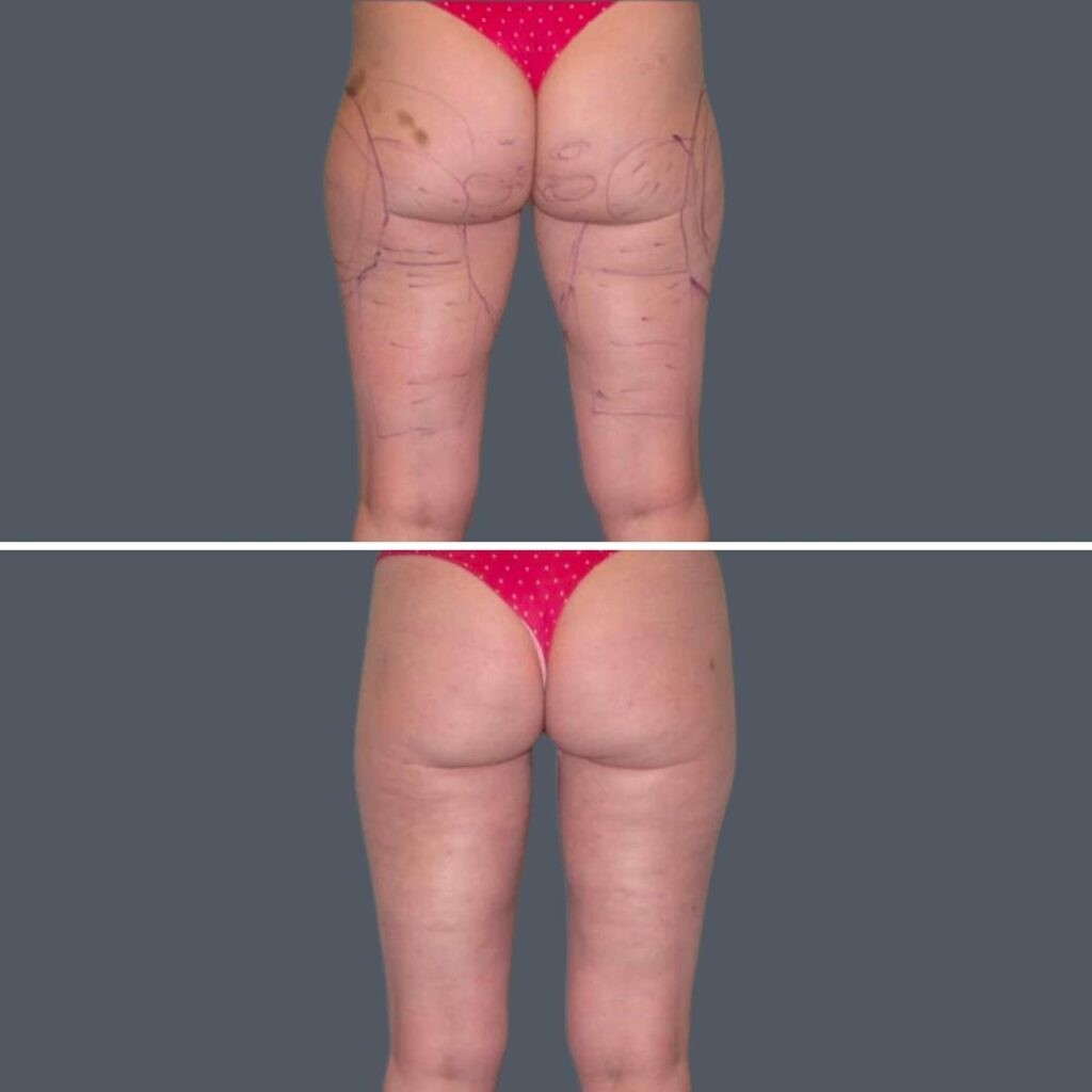 Cellulite Reduction Female Pre2024 017 Before And After