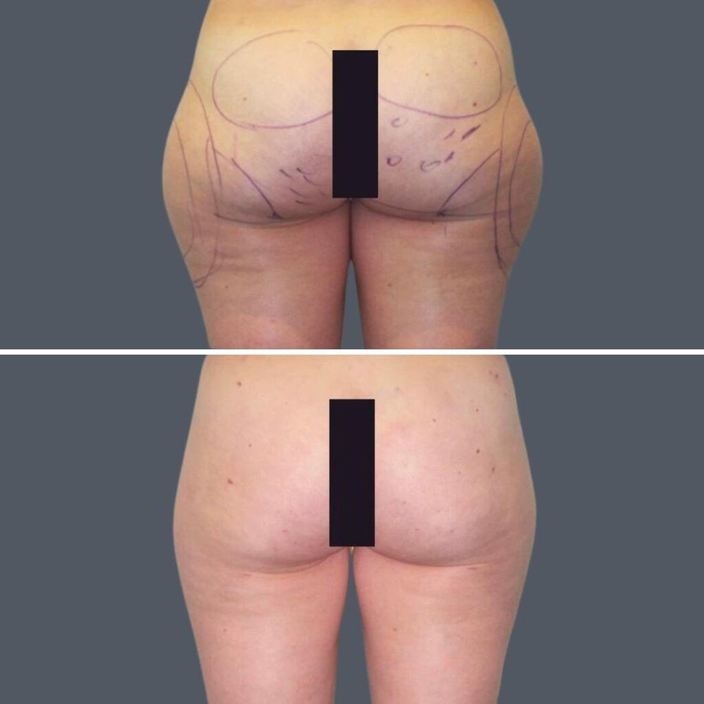 Cellulite Reduction Female Pre2024 018 Before And After