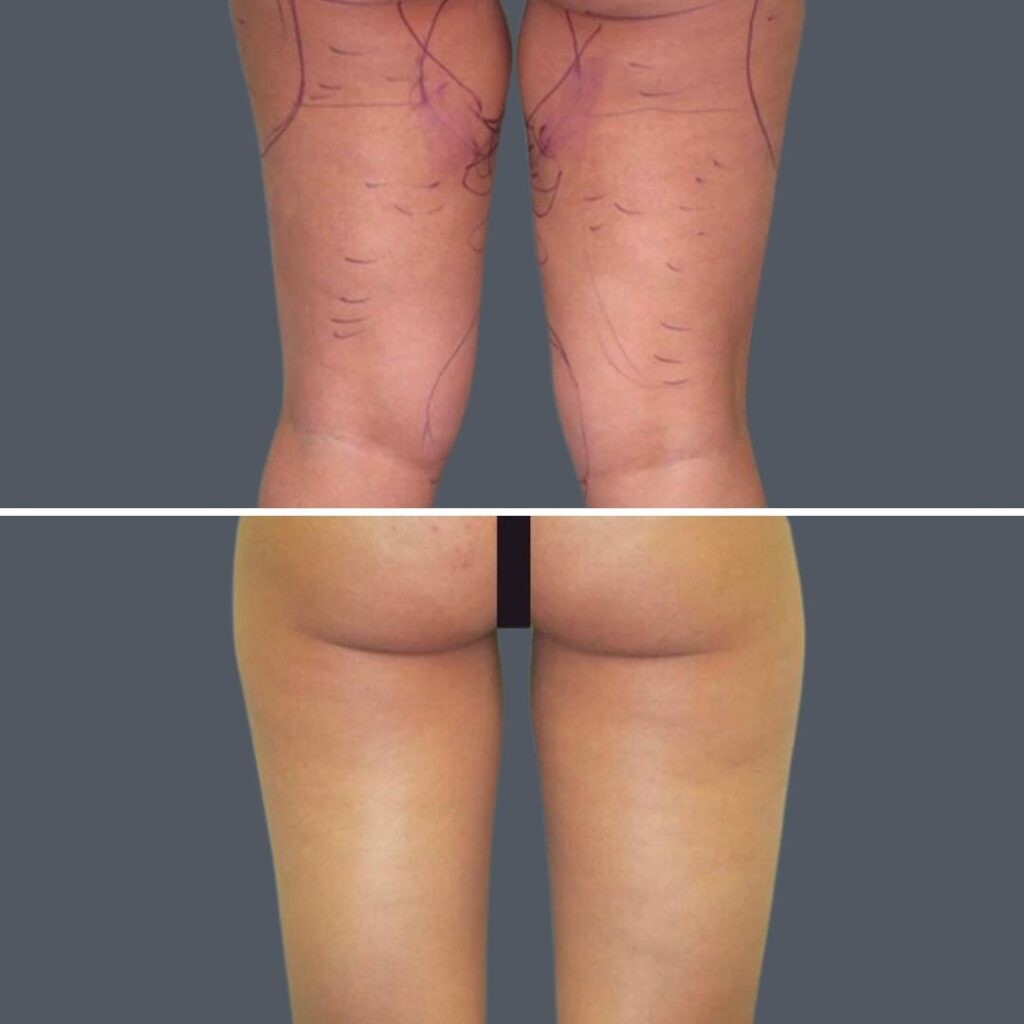 Cellulite Reduction Female Pre2024 019 Before And After