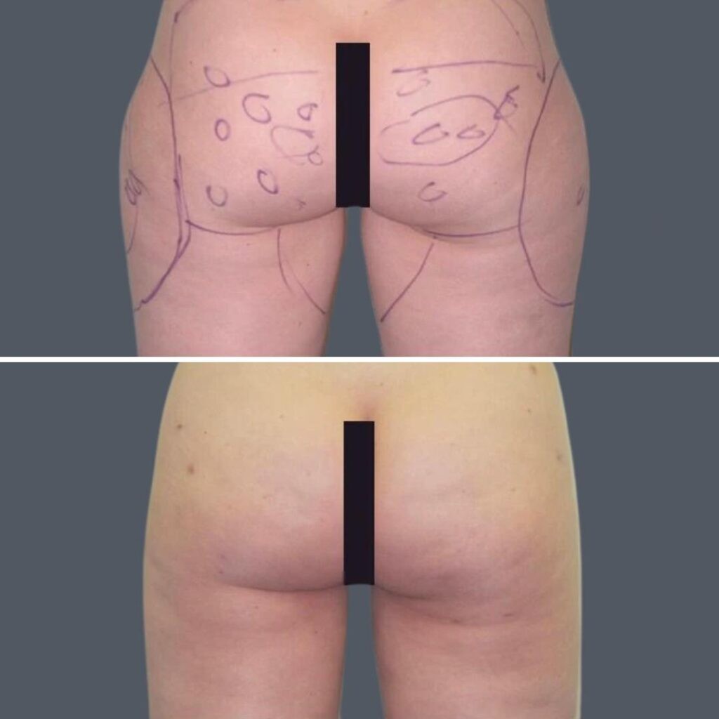 Cellulite Reduction Female Pre2024 020 Before And After