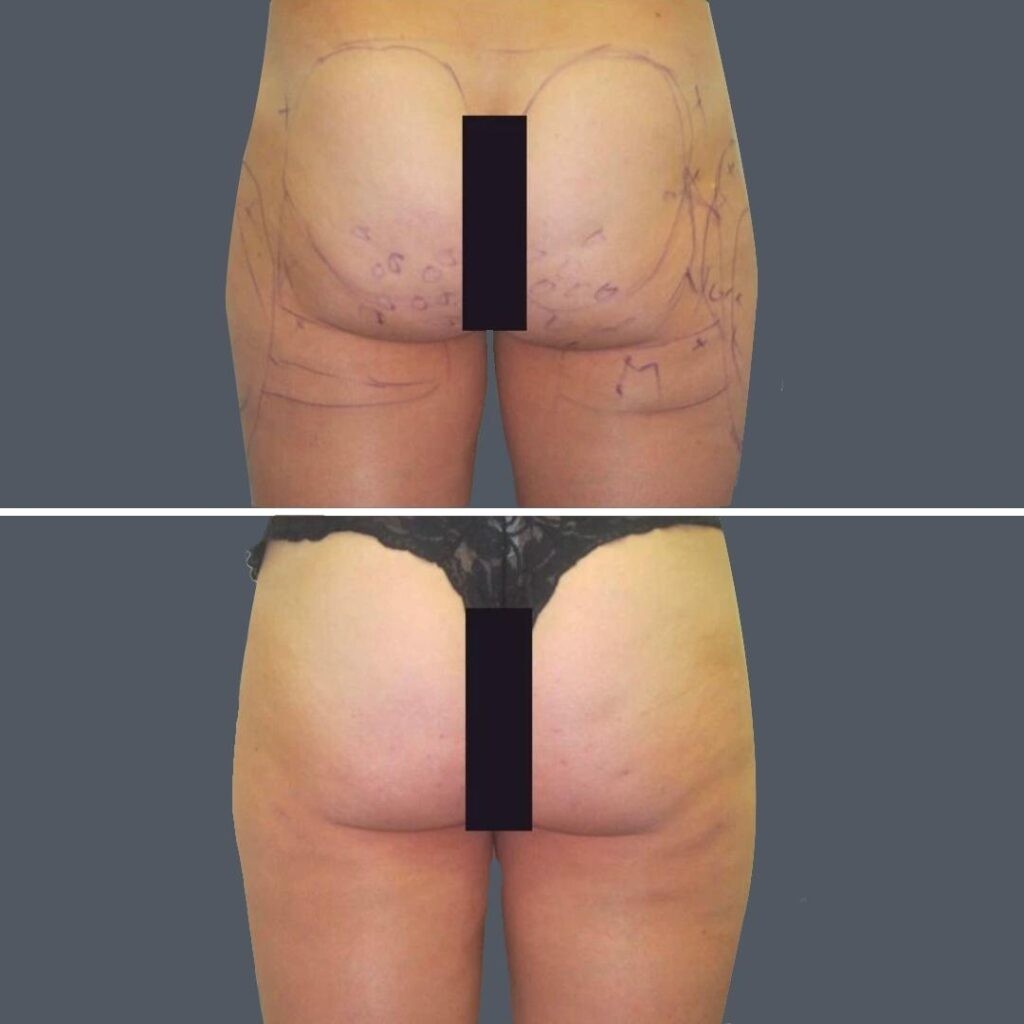 Cellulite Reduction Female Pre2024 021 Before And After