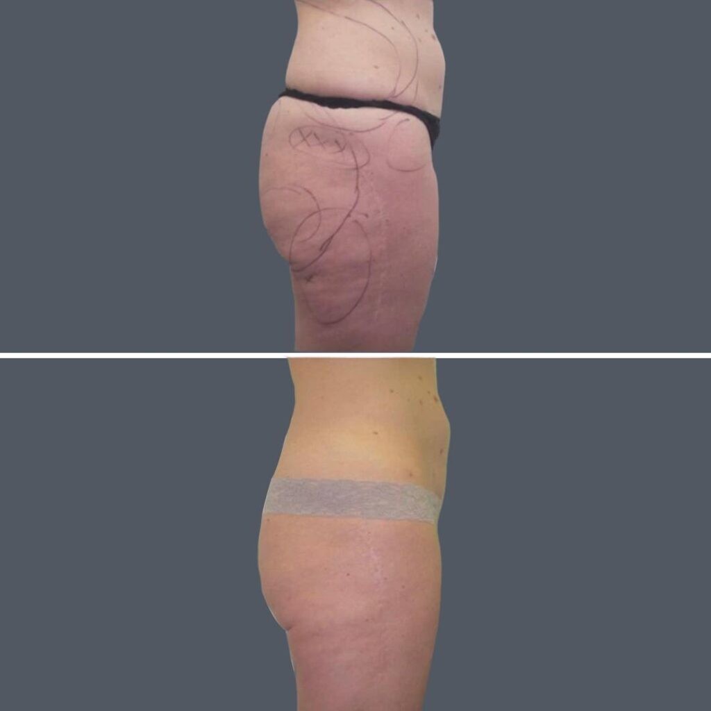 Cellulite Reduction Female Pre2024 022 Before And After