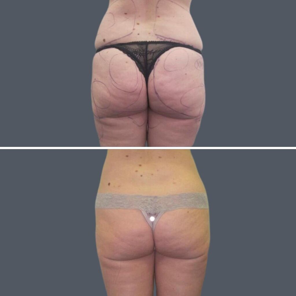 Cellulite Reduction Female Pre2024 023 Before And After