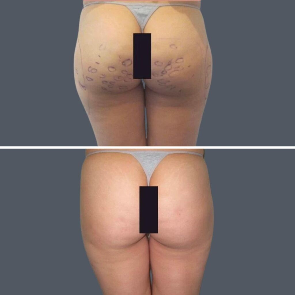 Cellulite Reduction Female Pre2024 024 Before And After