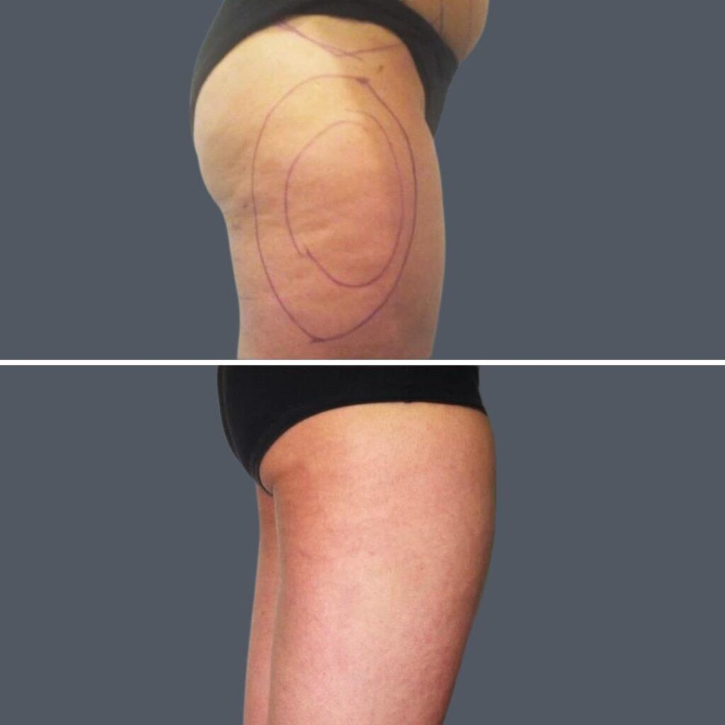 Cellulite Reduction Female Pre2024 025 Before And After